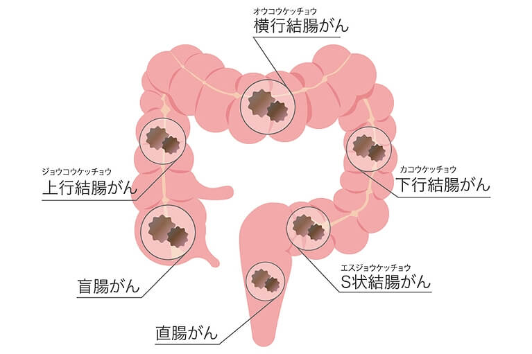 大腸がんとは